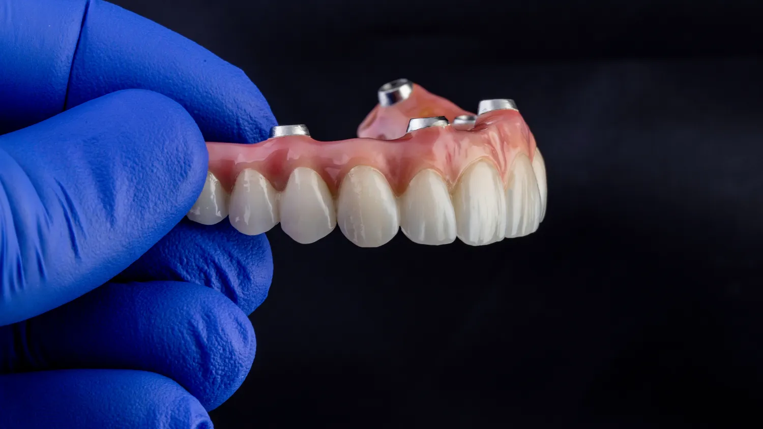 Rodzaje implantów zębowych