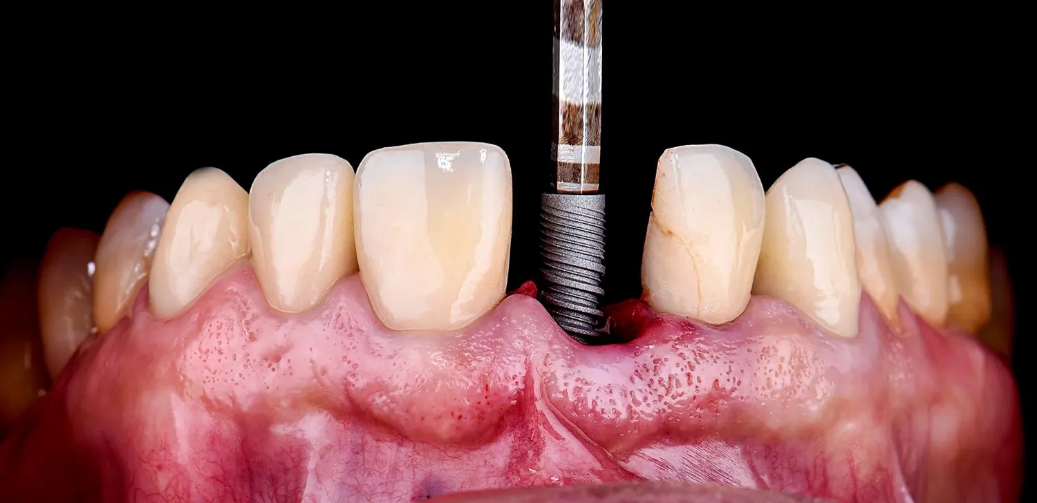 Zabiegi dentystyczne refundowane przez NFZ