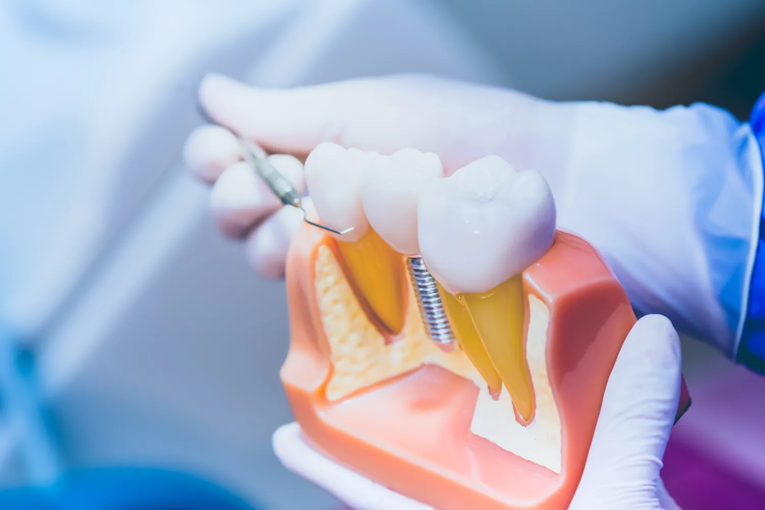 Co należy wiedzieć przed wyborem implantu zęba?