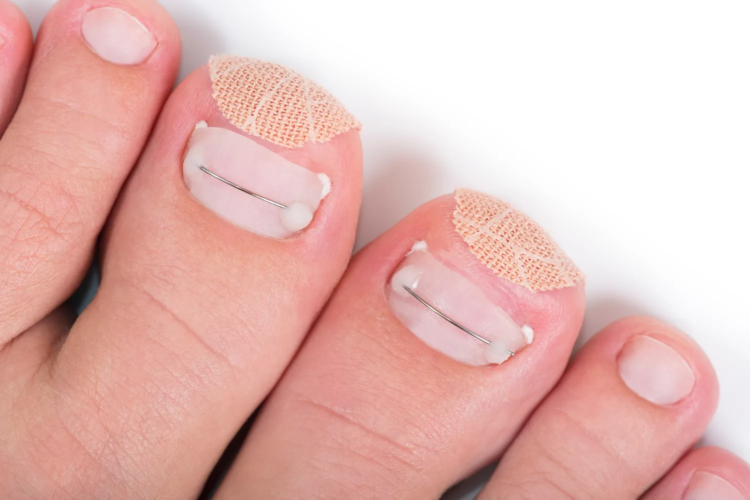 Pedicure leczniczy - czym jest, jak wygląda, kiedy warto go wybrać?