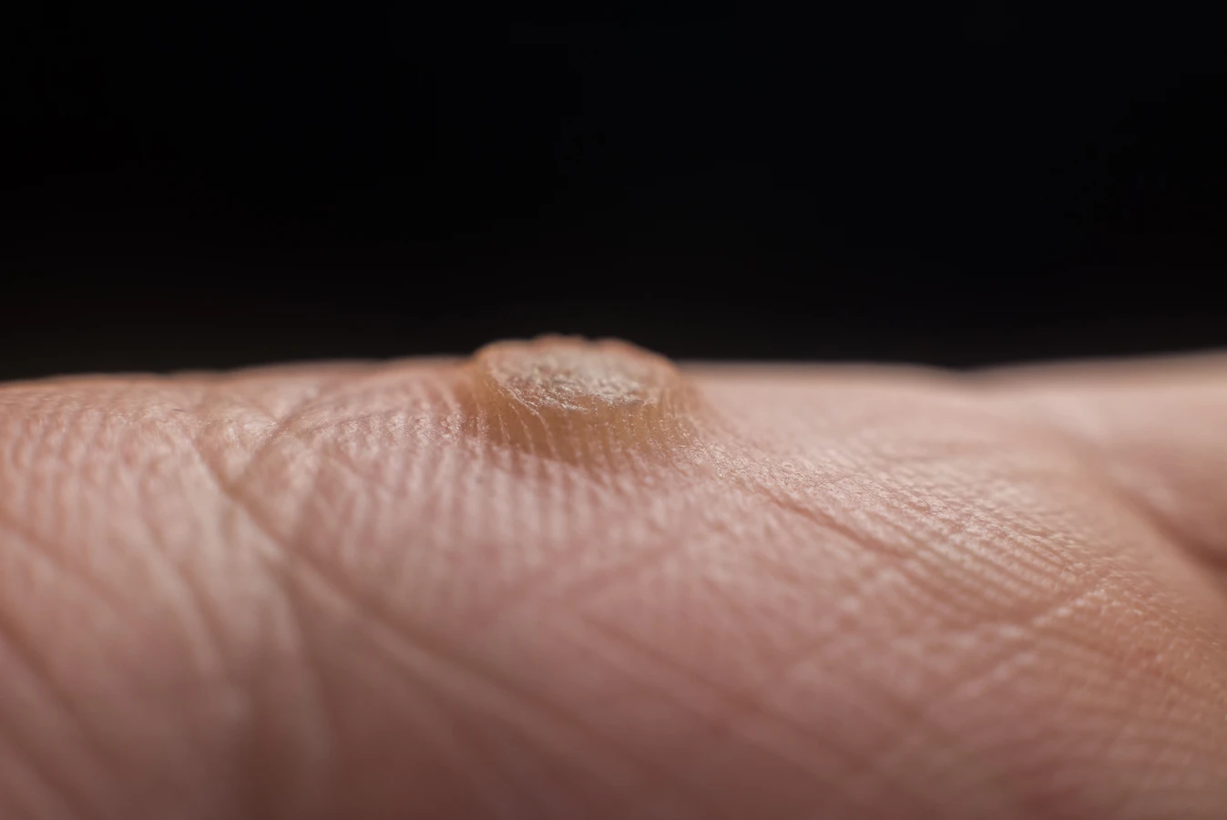 Od czego się robią kurzajki?